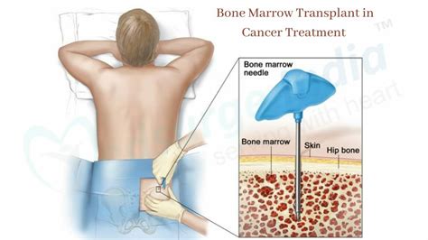 bone marrow transplant pcso|Cancers .